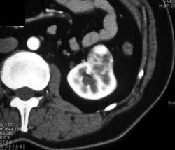 Renal Cell Carcinoma - CTisus CT Scan