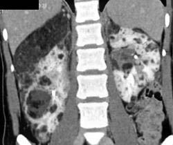 Von Hippel-Lindau syndrome (VHL) With Multiple Angiomyolipomas - CTisus CT Scan