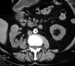 Renal Cell Carcinoma - CTisus CT Scan