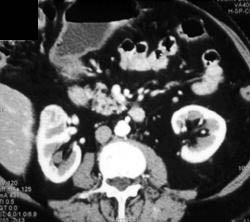 Renal Cell Carcinoma Best Seen on Delayed Phase Imaging - CTisus CT Scan