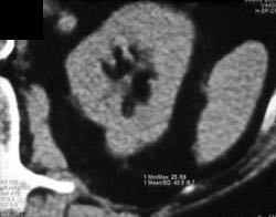 High Density Renal Cyst - CTisus CT Scan