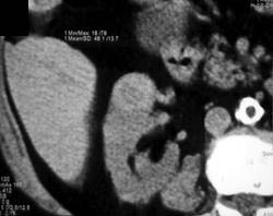 Renal Cell Carcinoma - CTisus CT Scan