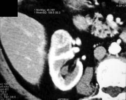 Renal Cell Carcinoma Best Seen on Excretory Phase - CTisus CT Scan