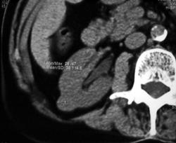 High Density Renal Cyst - CTisus CT Scan