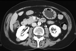 High Density Renal Cyst - CTisus CT Scan