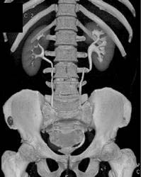 Dilated Left Renal Pelvis (ct Urogram) - CTisus CT Scan