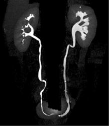 Transitional Cell Carcinoma in Distal Left Ureter - CTisus CT Scan