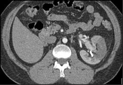 Acute Pyelonephritis - CTisus CT Scan