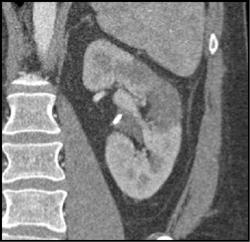 Acute Pyelonephritis - CTisus CT Scan