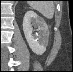 Renal Infarct - CTisus CT Scan