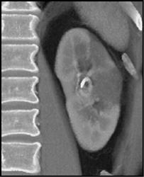 Renal Infarct - CTisus CT Scan