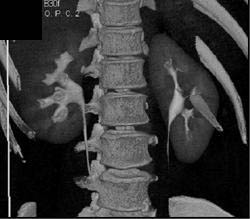 Normal CT Urogram - CTisus CT Scan