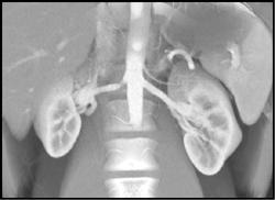 2 Left Renal Arteries - CTisus CT Scan