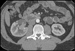 Transitional Cell Cancer (TCC) Kidney Plus Ureteropelvic Junction (UPJ) Due to Crossing Vessel - CTisus CT Scan