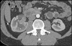 Transitional Cell Carcinoma - CTisus CT Scan