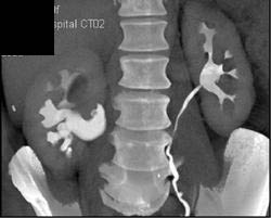 Transitional Cell Carcinoma - CTisus CT Scan