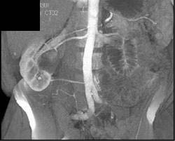 Transitional Cell Carcinoma With 3 Renal Arteries - CTisus CT Scan