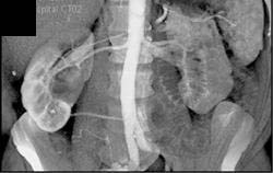 Transitional Cell Carcinoma - CTisus CT Scan