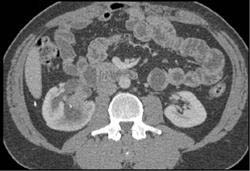 Transitional Cell Cancer (TCC) - CTisus CT Scan
