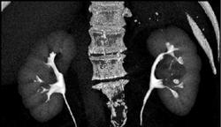 Parapelvic Renal Cysts - CTisus CT Scan