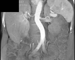 Prehilar Branching in Left Renal Artery - CTisus CT Scan