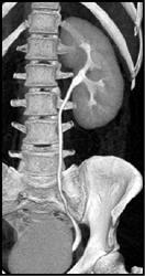 Normal Left Kidney and Ureter - CTisus CT Scan