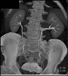 Normal CT Urogram With Large Prostate - CTisus CT Scan