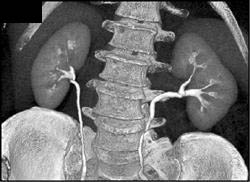 Normal CT Urogram With Large Prostate - Kidney Case Studies - CTisus CT ...