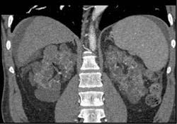 Uremic Cystic Disease - CTisus CT Scan