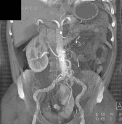 Pelvic Kidney With Stones in Renal Pelvis - CTisus CT Scan