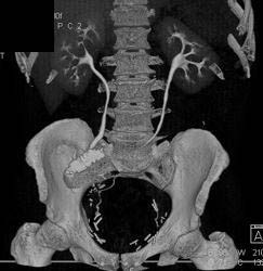 Anastomosis of Ureter to Small Bowel Loop - CTisus CT Scan