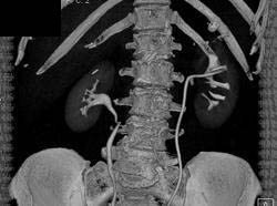 Stent in Left Renal Pelvis - CTisus CT Scan