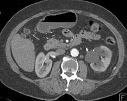 Left Hydronephrosis With Delayed Left Renal Function - CTisus CT Scan