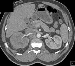 Transitional Cell Carcinoma - CTisus CT Scan