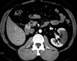 Renal Infarct - CTisus CT Scan