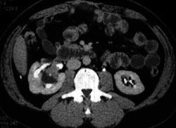 Transitional Cell Carcinoma - CTisus CT Scan