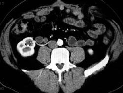 Crossing Vessel Causes Right Hydronephrosis - CTisus CT Scan