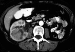 Renal Cell Carcinoma - CTisus CT Scan