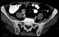 Transitional Cell Carcinoma of the Ureter - CTisus CT Scan