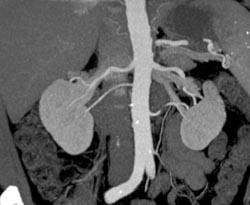 Multiple Renal Arteries - CTisus CT Scan