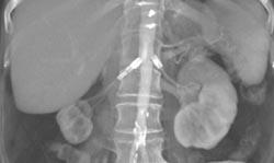 Stents in Renal Arteries With Narrowing of Right Renal Artery Post Stent - CTisus CT Scan