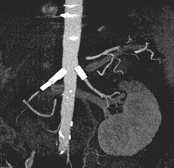 Stent in Renal Arteries - CTisus CT Scan