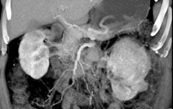 Renal Cell Carcinoma - CTisus CT Scan