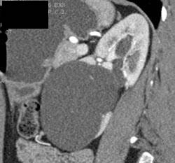 Renal Cyst - CTisus CT Scan