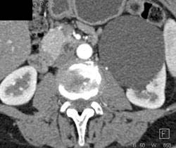 Renal Cyst - CTisus CT Scan