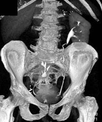 Pelvic Kidney - CTisus CT Scan