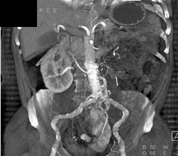 Pelvic Kidney With Stone in Renal Pelvis - CTisus CT Scan