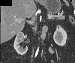 Renal Cell Carcinoma - CTisus CT Scan