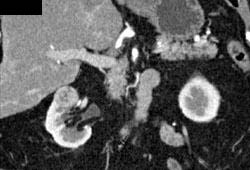 Renal Cell Carcinoma - CTisus CT Scan