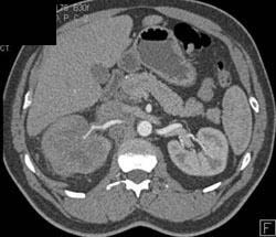 Transitional Cell Carcinoma - CTisus CT Scan